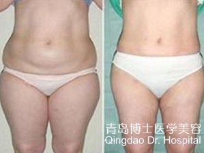 抽脂手术价格概览，了解抽脂费用及大致价格范围